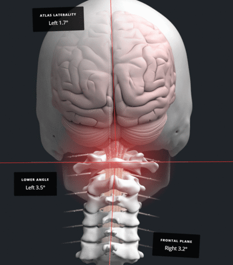 Diagram of a head and neck misalignment at the craniocervical junction