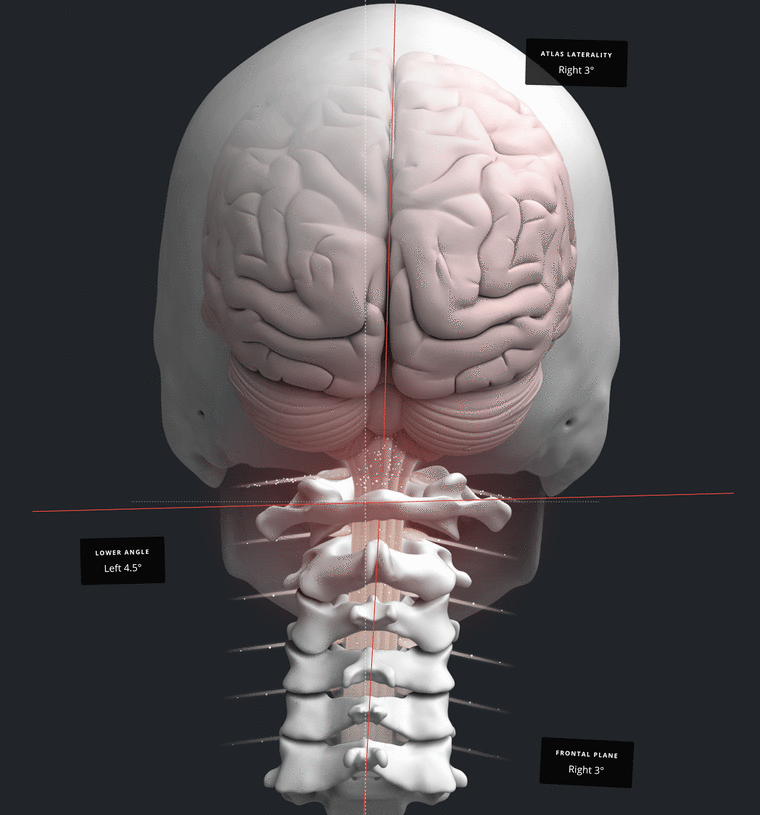 Illustration showing how head and neck misalignment affects balance signals
