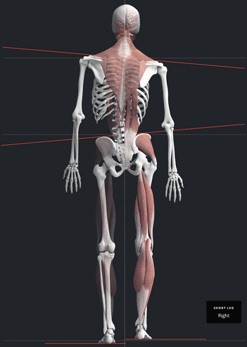 Diagram of full-spine compensation from an upper neck misalignment